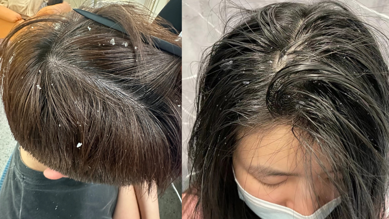 Gàu ngứa da đầu tăng sinh mạnh vào mùa lạnh