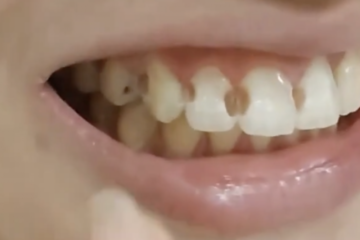 Đeo niềng 5 năm, cô gái phát hiện 8 răng bị thủng lỗ