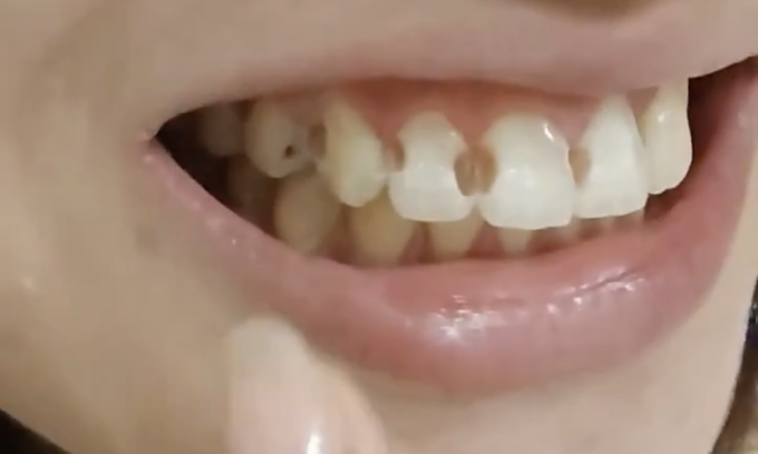 Khi tháo niềng, Huân Huân phát hiện 8 chiếc răng bị tổn thương ở các mức độ khác nhau. Ảnh cắt từ clip