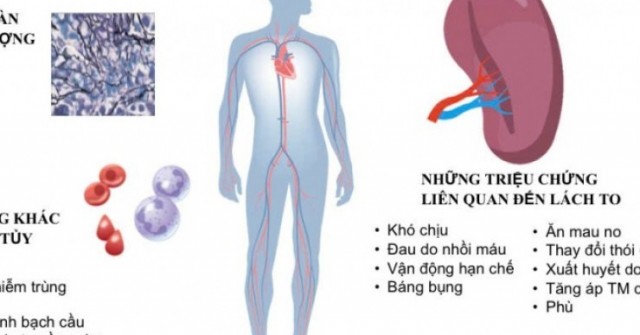 Xơ tủy - bệnh lý huyết học ác tính nguy hiểm