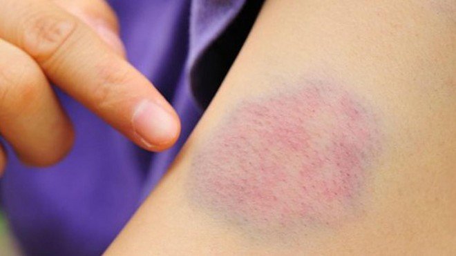 Không phải mọi vết bầm tím đều đồng nghĩa với rối loạn tiểu cầu