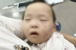 Tin tức trong ngày - Xác minh vụ bé gái có nhiều vết bầm trên mặt khi gửi ở cơ sở mầm non