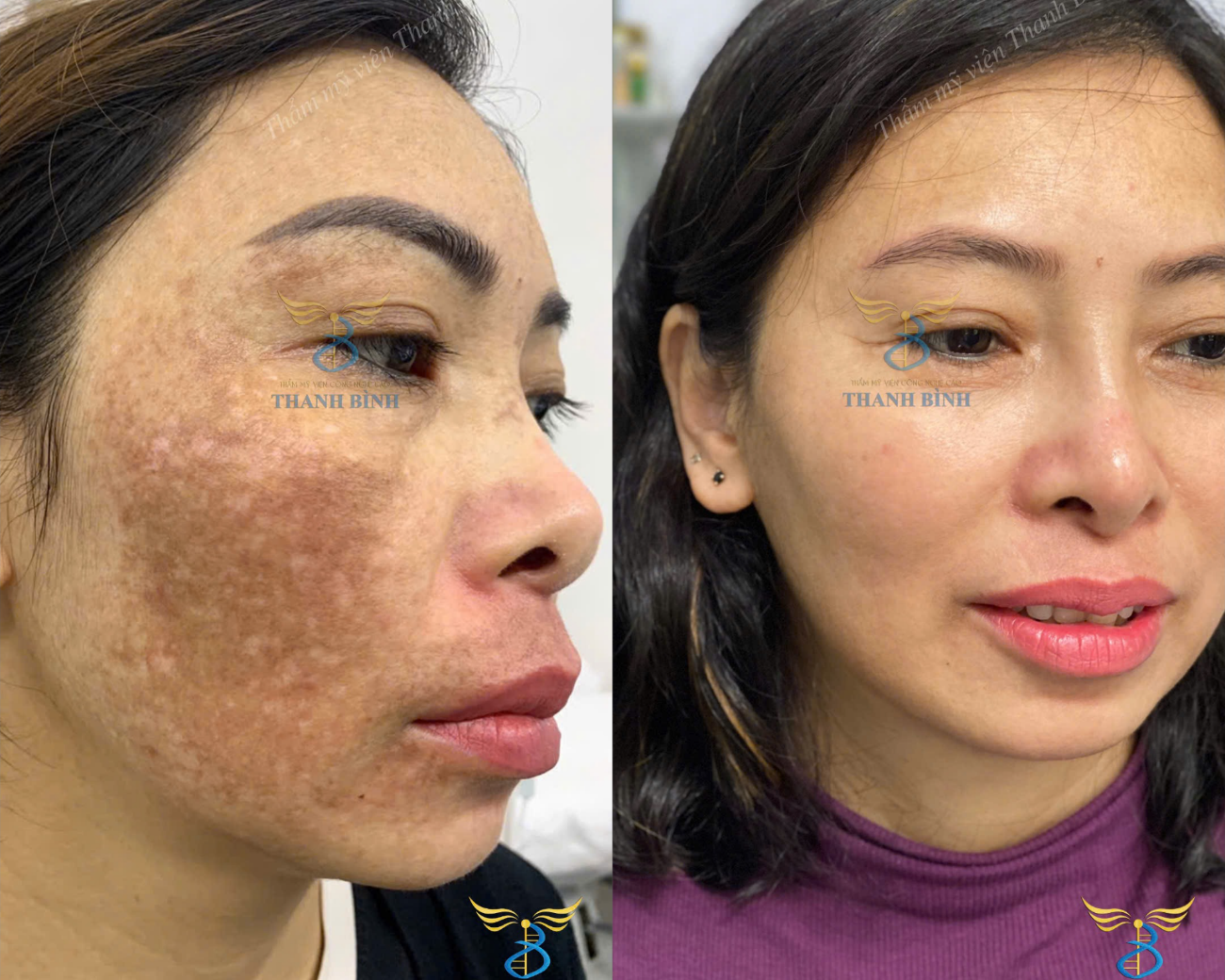 Hình ảnh trước và sau điều trị của chị Sinh tại TMV Thanh Bình