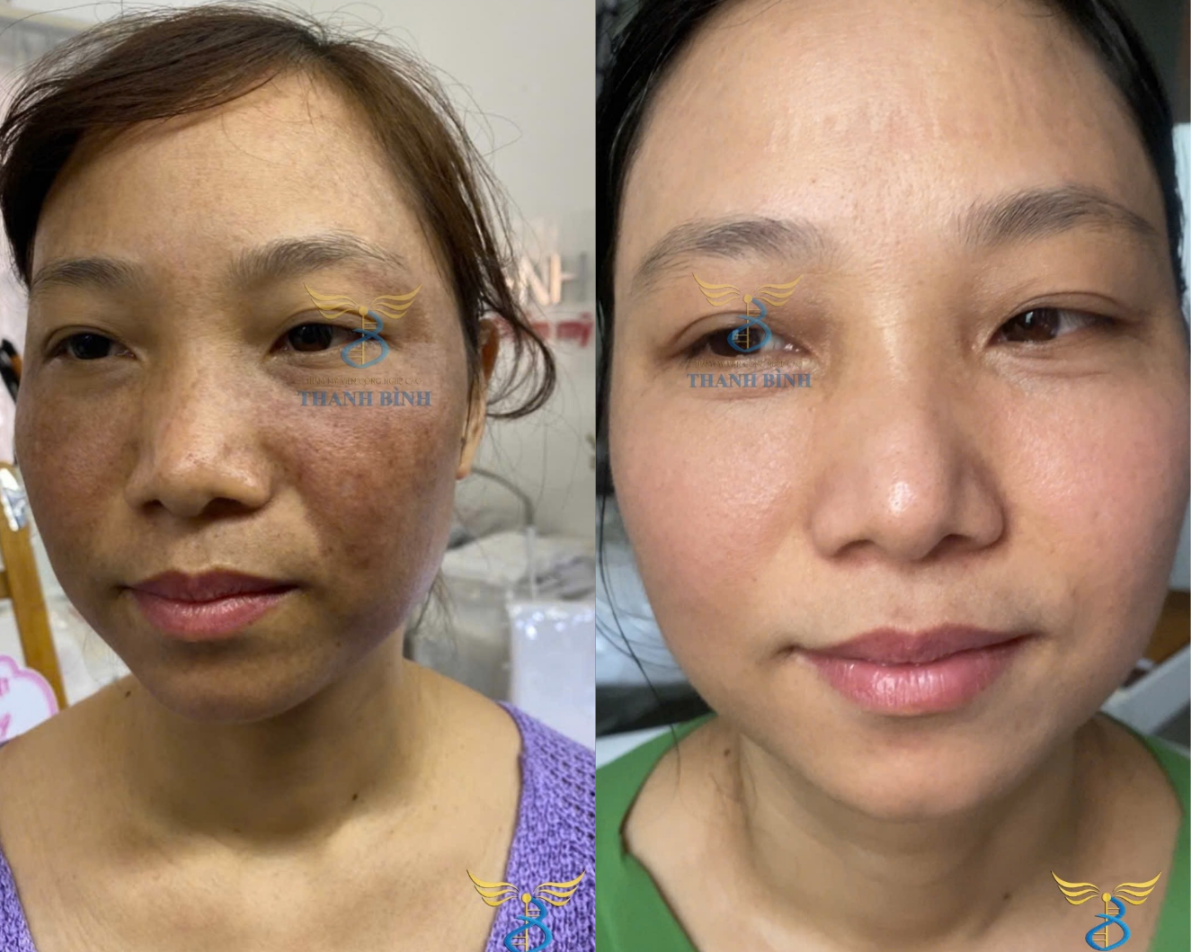 Hình ảnh trước và sau điều trị của chị Nụ tại TMV Thanh Bình