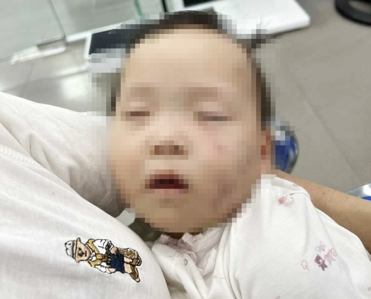 Hình ảnh cháu V có nhiều vết bầm tím trên mặt.