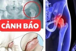Tin tức sức khỏe - Đau nhức háng tận trong xương cần phải làm ngay điều này!