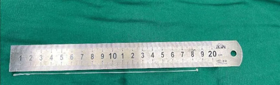 Bác sĩ gắp ra ký sinh trùng dài 18cm.