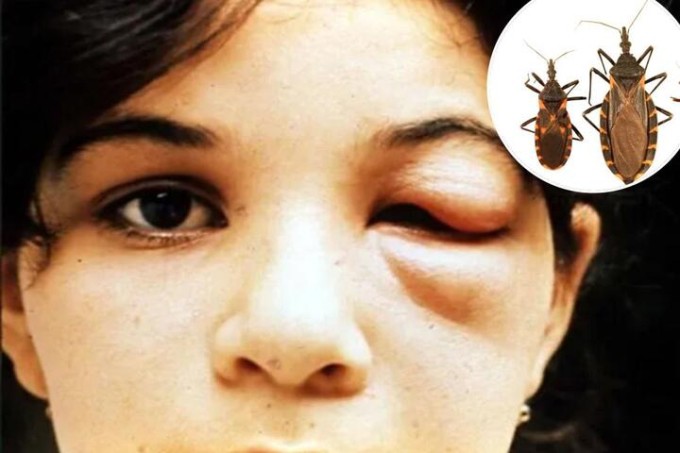 Sưng mí mắt là một trong những biểu hiện của bệnh Chagas do loài bọ hôn gây ra. Ảnh: NY Post