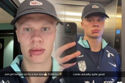 Haaland phải khâu 3 mũi sau tai nạn hy hữu, Odegaard bị réo tên là "thủ phạm"