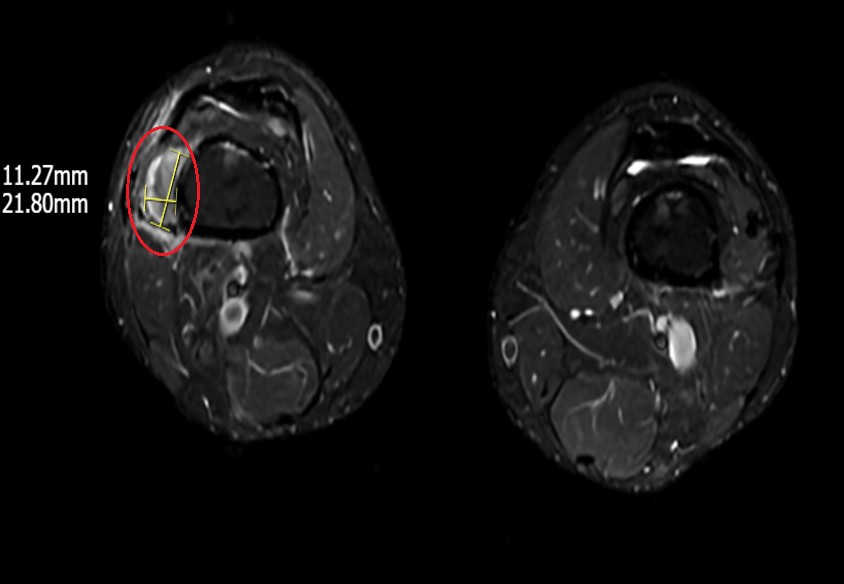 Hình ảnh khối u vùng vị trí phần mềm dưới đùi phải trên phim MRI