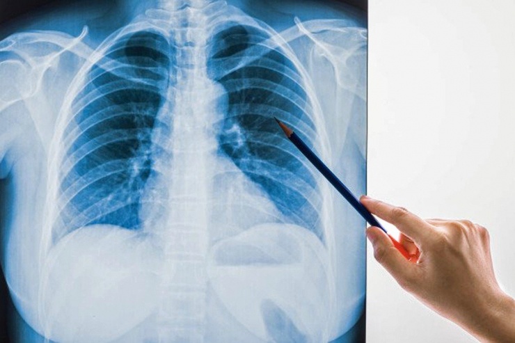 Ung thư phổi không di truyền trực tiếp, nhưng đột biến gen mang tính chất gia đình có thể làm tăng nguy cơ. Người có tiền sử gia đình mắc ung thư phổi (cha mẹ, anh chị em) có nguy cơ cao gấp 2-3 lần. Chúng tôi khuyến cáo nhóm này tầm soát sớm từ tuổi 40. Ảnh minh họa: Internet