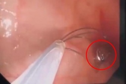 Bé trai tàn tật suốt đời vì nuốt pin cúc áo