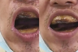 Thị trường - Tiêu dùng - Bỏ 18.000 đồng tự hàn răng vì tiếc tiền đi nha sĩ, nhận cái kết “thảm họa"