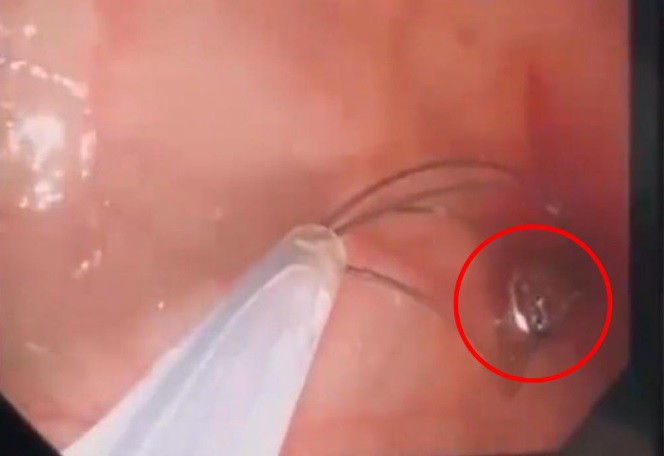 Pin cúc áo trong cơ thể bé trai.