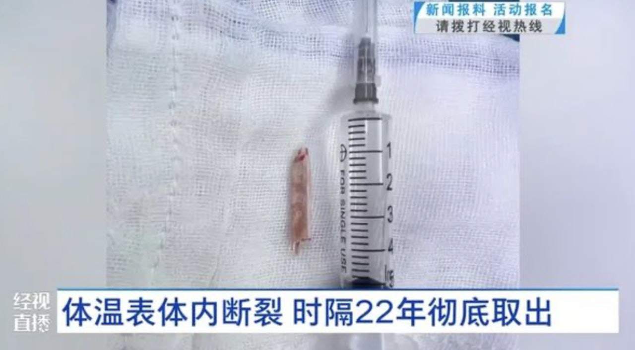 Nhiệt kế gãy được lấy ra.
