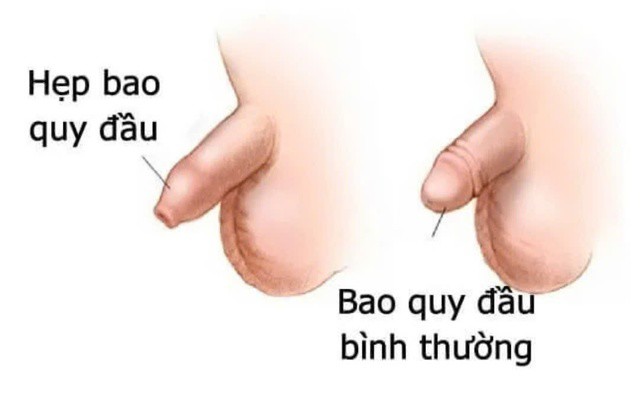 Hình ảnh hẹp bao quy đầu ở trẻ.