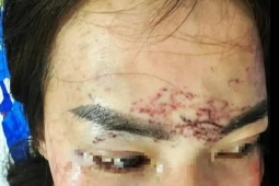 An ninh - Xã hội - Diễn biến vụ 2 phụ nữ đánh ghen, đổ axit, xăm mặt người khác ở Cà Mau