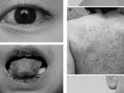 Trẻ mắc bệnh hiếm gặp gây đột tử, bác sĩ chẩn đoán bị... viêm họng