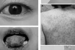 Trẻ mắc bệnh hiếm gặp gây đột tử, bác sĩ chẩn đoán bị... viêm họng