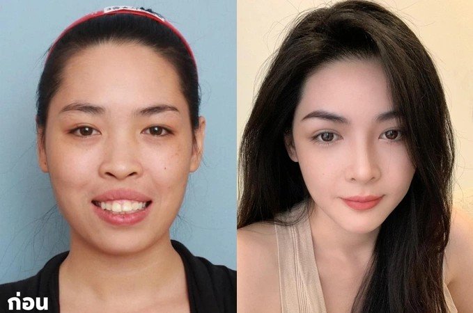 Trước khi tham gia chương trình phẫu thuật thẩm mỹ, Vũ Thanh Quỳnh có ngoại hình kém sắc, hàm hô, gương mặt thô, ánh nhìn thiếu tự tin. Cũng chính bởi vậy mà cô luôn thấy mặc cảm, hạn chế tiếp xúc với bạn bè và cũng không dám mơ ước quá xa vì nghĩ rằng ngoại hình là rào cản trên con đường lập nghiệp.