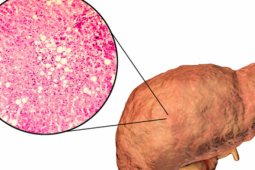 Sức khỏe đời sống - Gan nhiễm độc nguy hiểm hơn bạn nghĩ: 5 dấu hiệu thầm lặng nhiều người bỏ qua