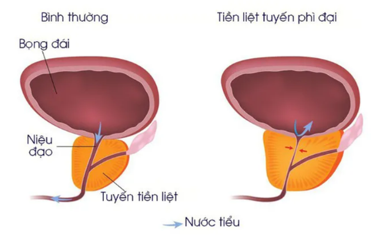 3 dấu hiệu thầm lặng cảnh báo phì đại tuyến tiền liệt mà nhiều quý ông chủ quan - 2