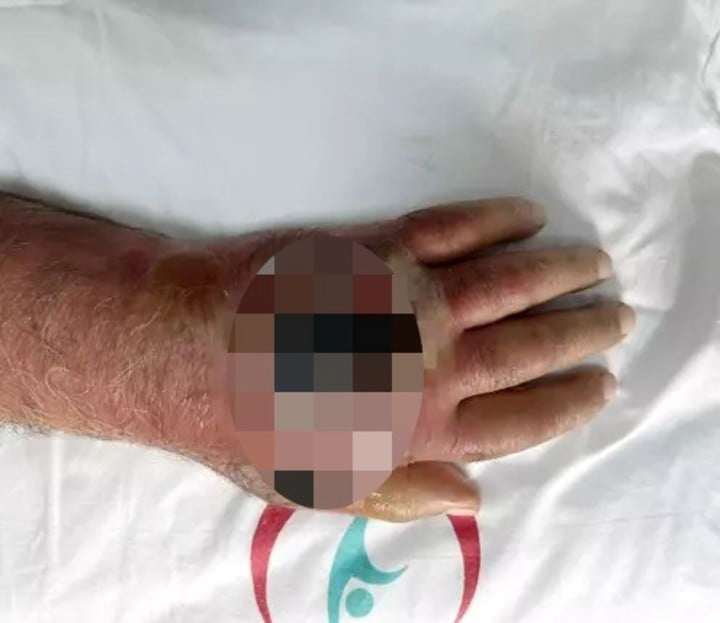 Tay của người đàn ông bị nhiễm trùng nghiêm trọng.