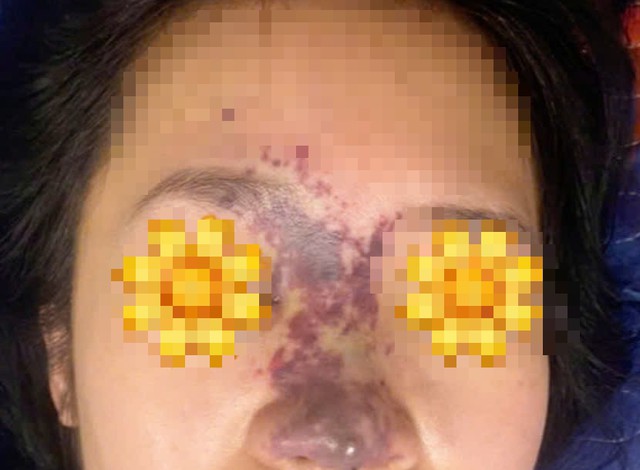 Bệnh nhân thâm tím vùng mũi lan lên mắt phải sau khi tiêm filler ở spa. Ảnh: BVCC.