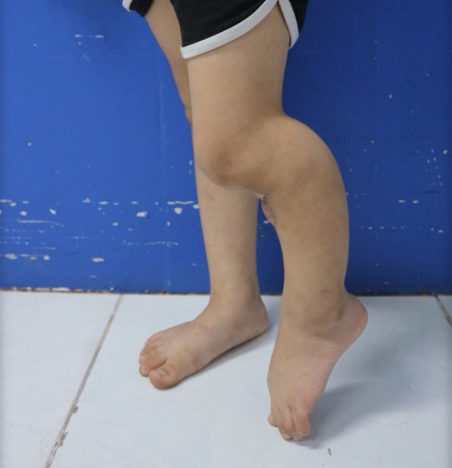 Chân của cháu bé biến dạng trước khi thực hiện phẫu thuật chuyển xương, chỉnh trục