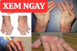 Tin tức sức khỏe - Giật mình thói quen cực nguy hiểm tàn phá xương khớp không phải ai cũng biết!