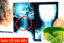 Tin tức sức khỏe - Loại thảo dược ít ai ngờ lại có thể xoa dịu đau lưng, đau cổ vai gáy hiệu quả bất ngờ!