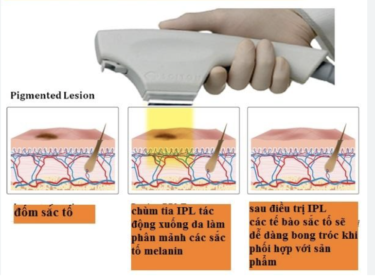 Mô phỏng quá trình tác động của IPL trong điều trị sắc tố.