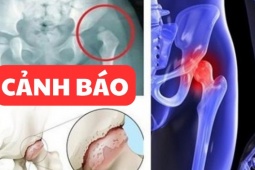 Tin tức sức khỏe - Đau nhức háng tận trong xương cần phải làm ngay điều này!
