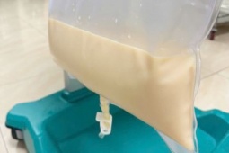 Người đàn ông có mỡ máu cao gấp 80 lần, huyết tương trắng như sữa