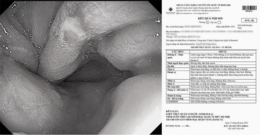 Một trường hợp người bệnh thừa cân, tăng mỡ cơ thể sau 2 năm, tiến triển thành GERD độ B và loét thực quản