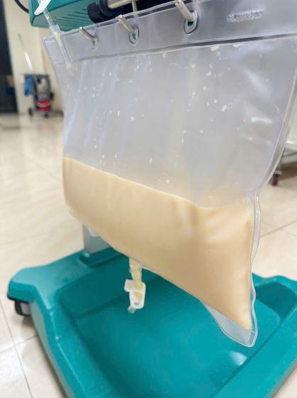 Huyết tương người bệnh trắng đục như sữa vào thời điểm nhập viện. Ảnh: Bệnh viện cung cấp
