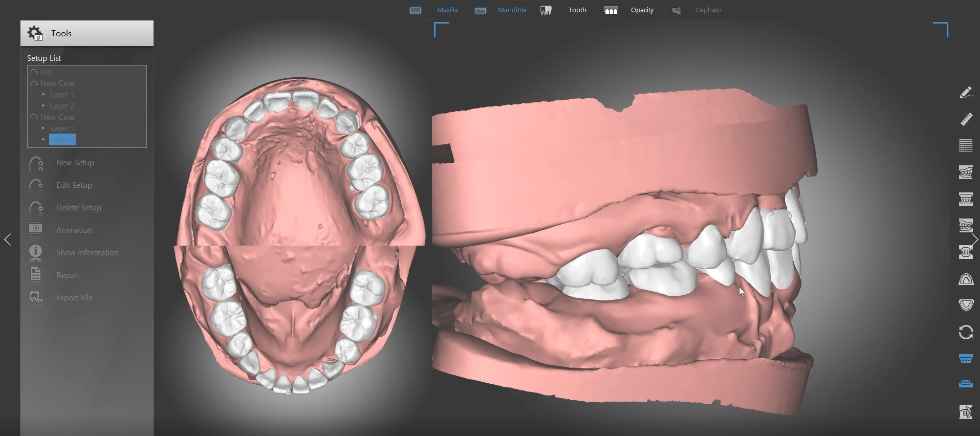 Giải pháp X-Matrix cho phép biết trước kết quả niềng răng trên video mô phỏng 3D