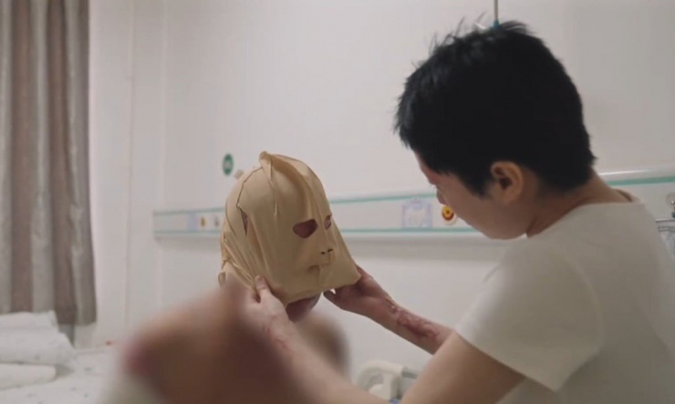 Gương mặt của cha Đồng Dao bị cháy, cần phải phẫu thuật ghép da diện rộng. Ông phải đeo mặt nạ đặc biệt hỗ trợ phục hồi.