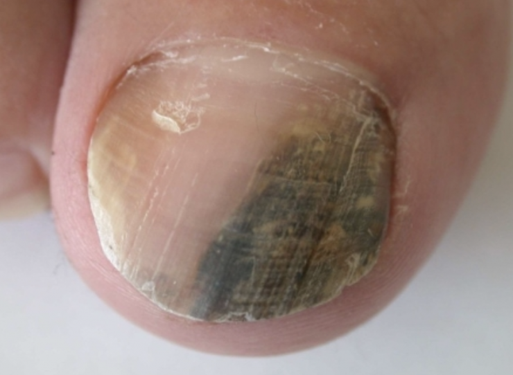 Hình ảnh bệnh nhân bị ung thư hắc tố ở móng. Ảnh: BSCC