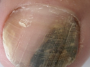 Căn bệnh ung thư tiên lượng xấu có thể bắt đầu từ một dải đen, thẳng ở móng