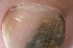 Căn bệnh ung thư tiên lượng xấu có thể bắt đầu từ một dải đen, thẳng ở móng