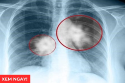 Tin tức sức khỏe - Tư thế ngủ tốt nhất cho phổi giúp giảm đàm, ho, thở dễ hơn: Rất nhiều người đang làm sai!