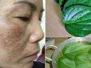 Mách bạn 4 cách trị nám lâu năm từ thiên nhiên, rẻ tiền nhưng cực nhạy
