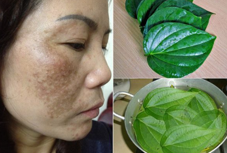 Trong lá trầu không chứa hàm lượng lớn vitamin C, hợp chất caroten và thiamin giúp đẩy lùi hắc tố melanin gây ra hiện tượng nám.
