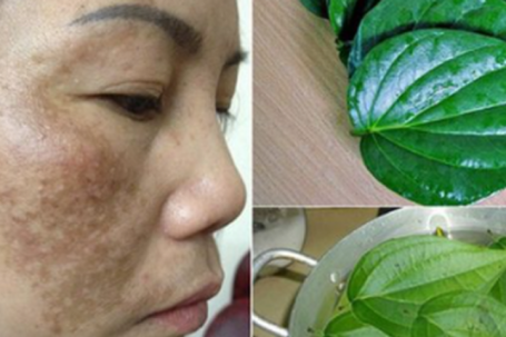 Mách bạn 4 cách trị nám lâu năm từ thiên nhiên, rẻ tiền nhưng cực nhạy