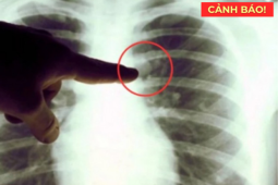 Tin tức sức khỏe - Đàm, ho, khó thở cứ tái đi tái lại: Nhiều người bỏ sót điều này