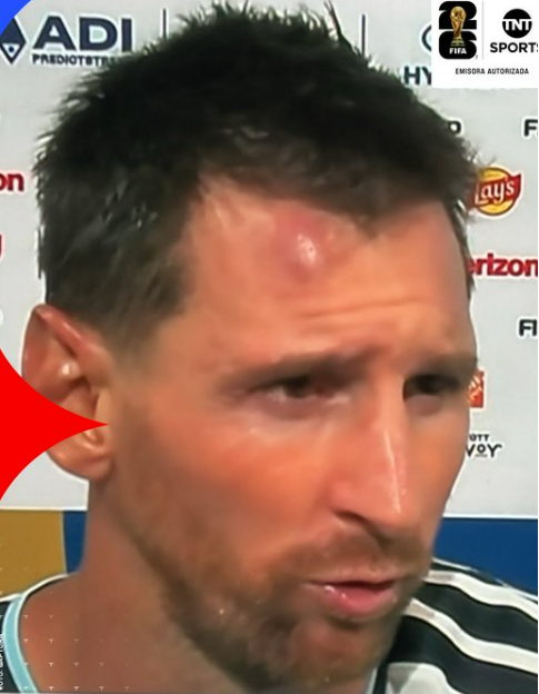 Cục u nổi rõ trên trán Messi sau trận