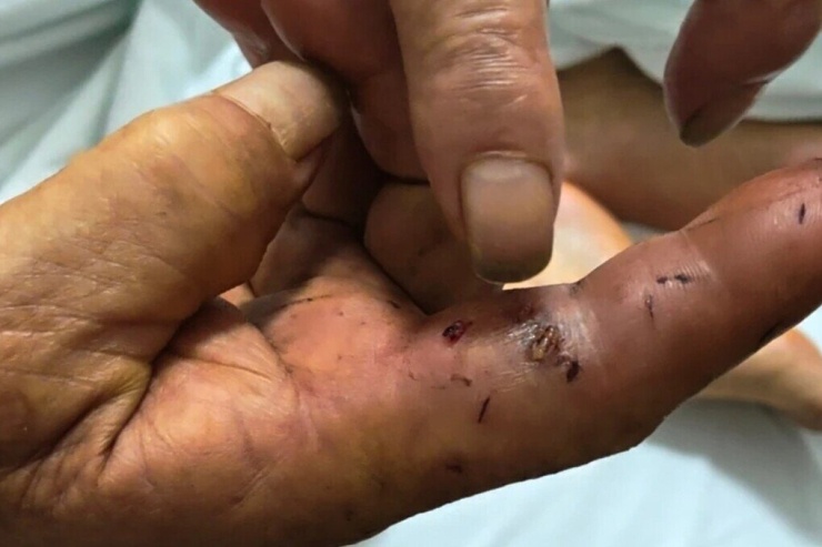 Người đàn ông bị rắn cắn vào ngón trỏ bàn tay phải. Ảnh: Jimu News