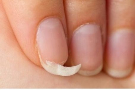 Móng tay giòn, dễ gãy là biểu hiện của những vấn đề sức khỏe không thể bỏ qua