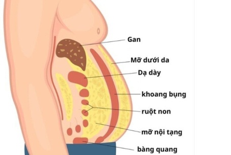Mỡ nội tạng nguy hiểm hơn mỡ dưới da như thế nào?